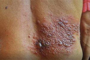 herpes-zoster-espalda